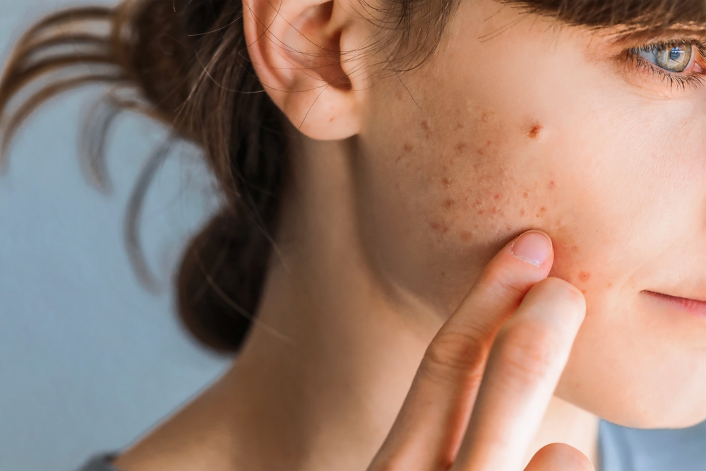 7 Face Masks for Acne That Actually Work Fast