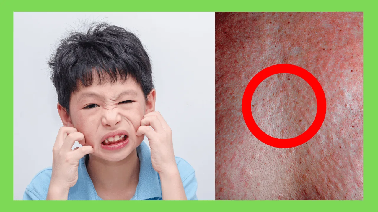 Skin Rashes in Children