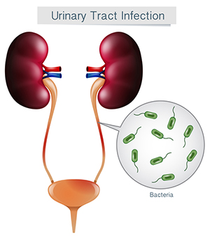 a diagram of urinary tract infection