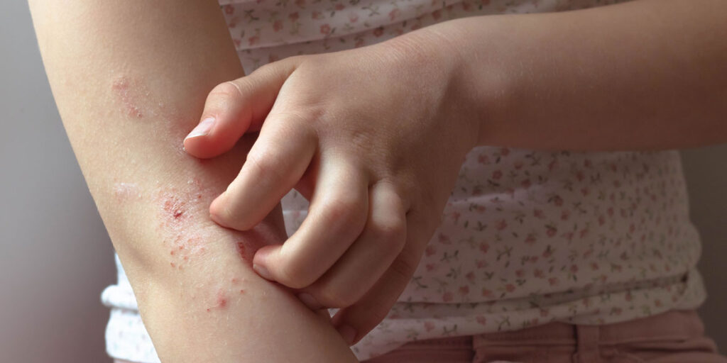 Understanding Skin Rashes in Children