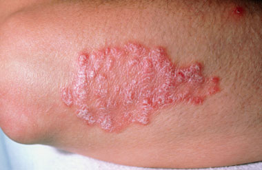 Skin Rashes in Children